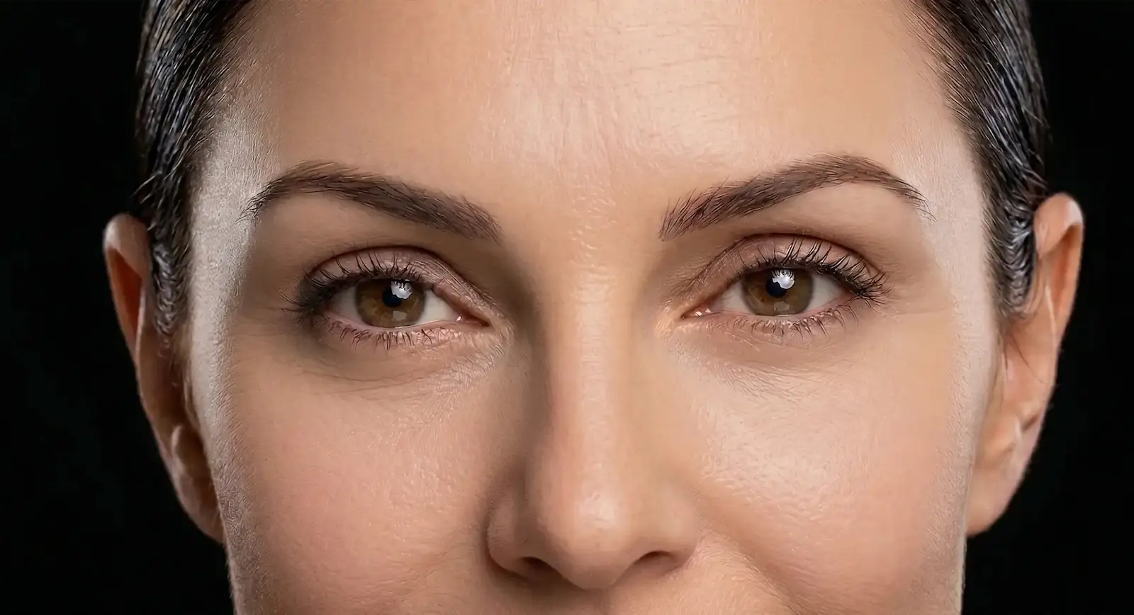 Blefaroplastia en Cali por Dr. Jaime Arias logrando una mirada descansada y juvenil sin exceso de piel.